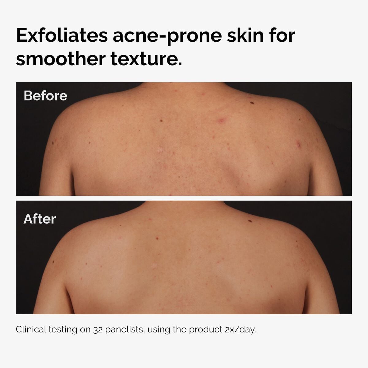 Salicylic Acid 0.5% Body Serum J1 image 6
